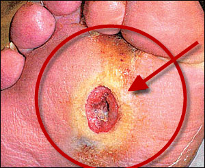 Diabetic Ulcers